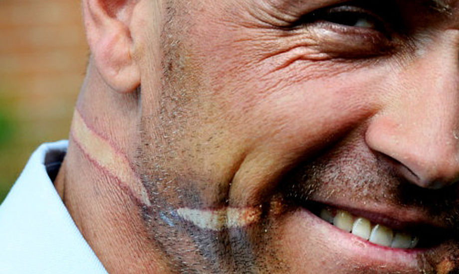 Mikkel Hartvig Andersen slap med blødende mundvige og et 270 grader brændemærke rundt om hovedet og på tværs af tungen, skriver Jyllands-Posten. Foto: Mikkel Hartvigs Facebookprofil